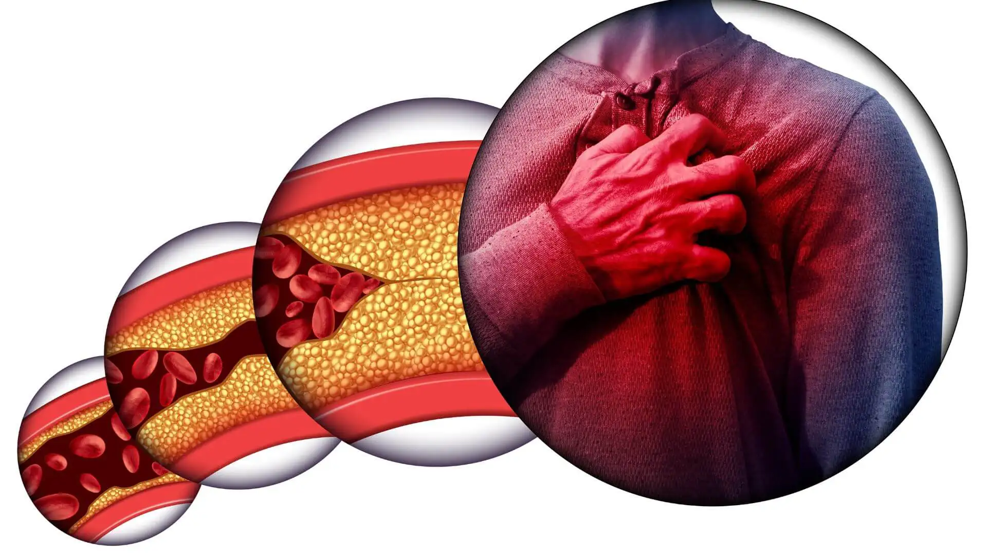 6 nguyên nhân gây tai biến mạch máu não 2 - Gimedi Pharma 6 nguyên nhân gây tai biến mạch máu não