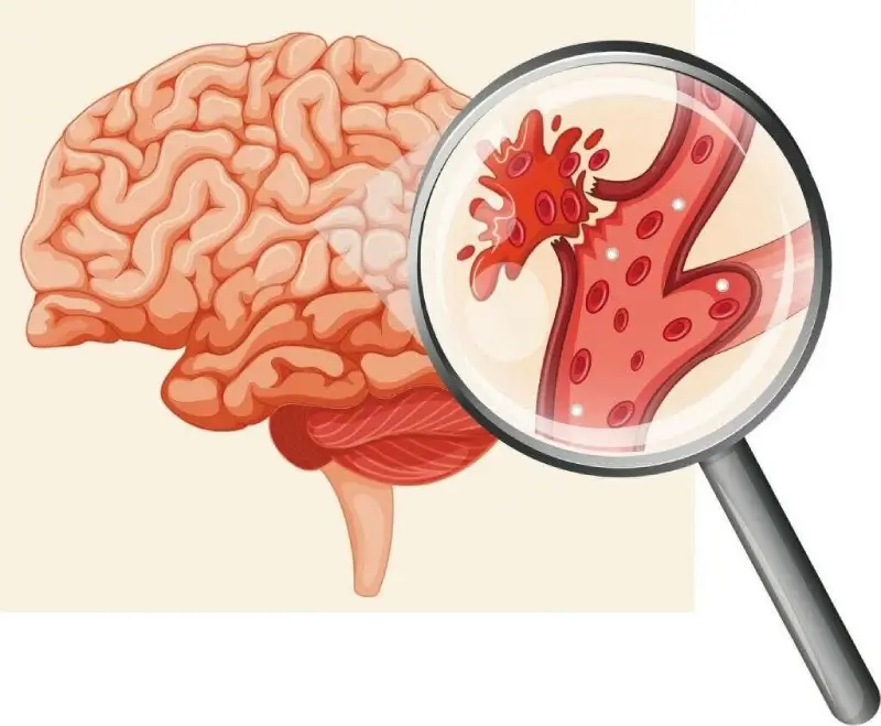 Dấu Hiệu Tai Biến Ở Người Trẻ