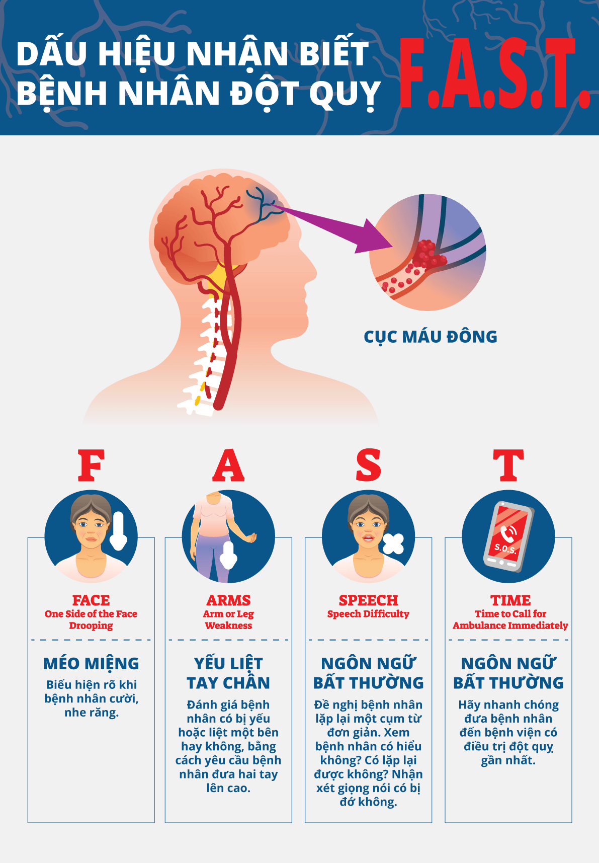 Đột quỵ: Nguyên nhân và cách phòng ngừa
