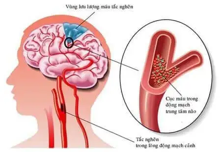 Đột quỵ: Nguyên nhân và cách phòng ngừa