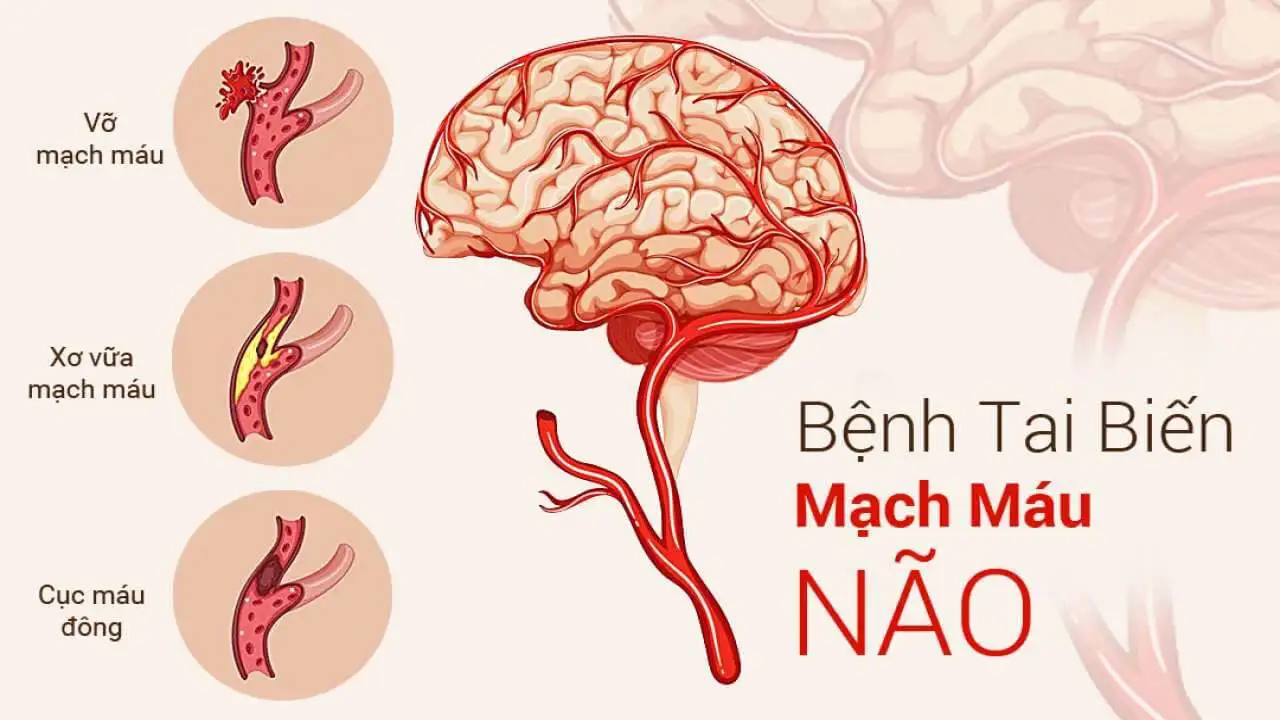 Dấu hiệu tai biến mạch máu não: Những điều ai cũng cần biết để xử lý kịp thời 1 - Gimedi Pharma Dấu hiệu tai biến mạch máu não: Những điều ai cũng cần biết để xử lý kịp thời