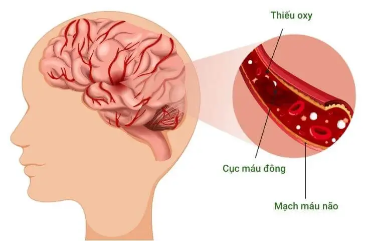 Những thói quen xấu khiến bạn dễ bị đột quỵ 1 - Gimedi Pharma Những thói quen xấu khiến bạn dễ đột quỵ