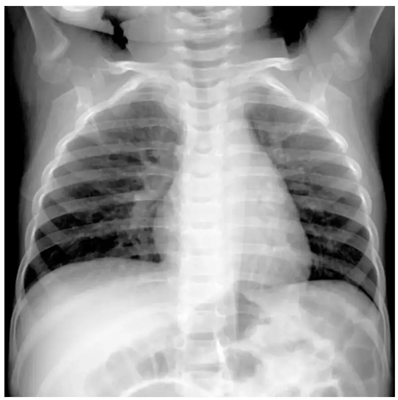 NHỮNG ĐIỀU VỀ HMPV, LOẠI VIRUS LÂY LAN PHỔ BIẾN ĐANG GÂY BỆNH TẠI TRUNG QUỐC 1 - Gimedi Pharma NHỮNG ĐIỀU CHÚNG TA BIẾT VỀ HUMAN METAPNEUMOVIRUS, LOẠI VIRUS LÂY LAN PHỔ BIẾN ĐANG GÂY BỆNH TẠI TRUNG QUỐC