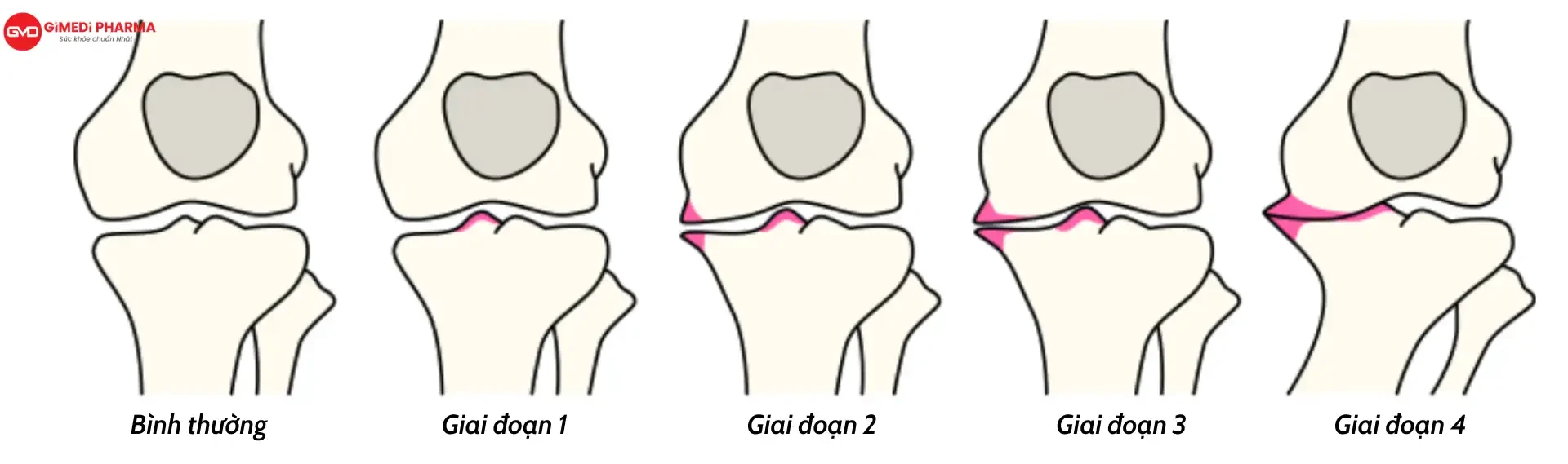 THOÁI HÓA KHỚP TIẾN TRIỂN ÂM THẦM, CÓ CHỮA ĐƯỢC KHÔNG?