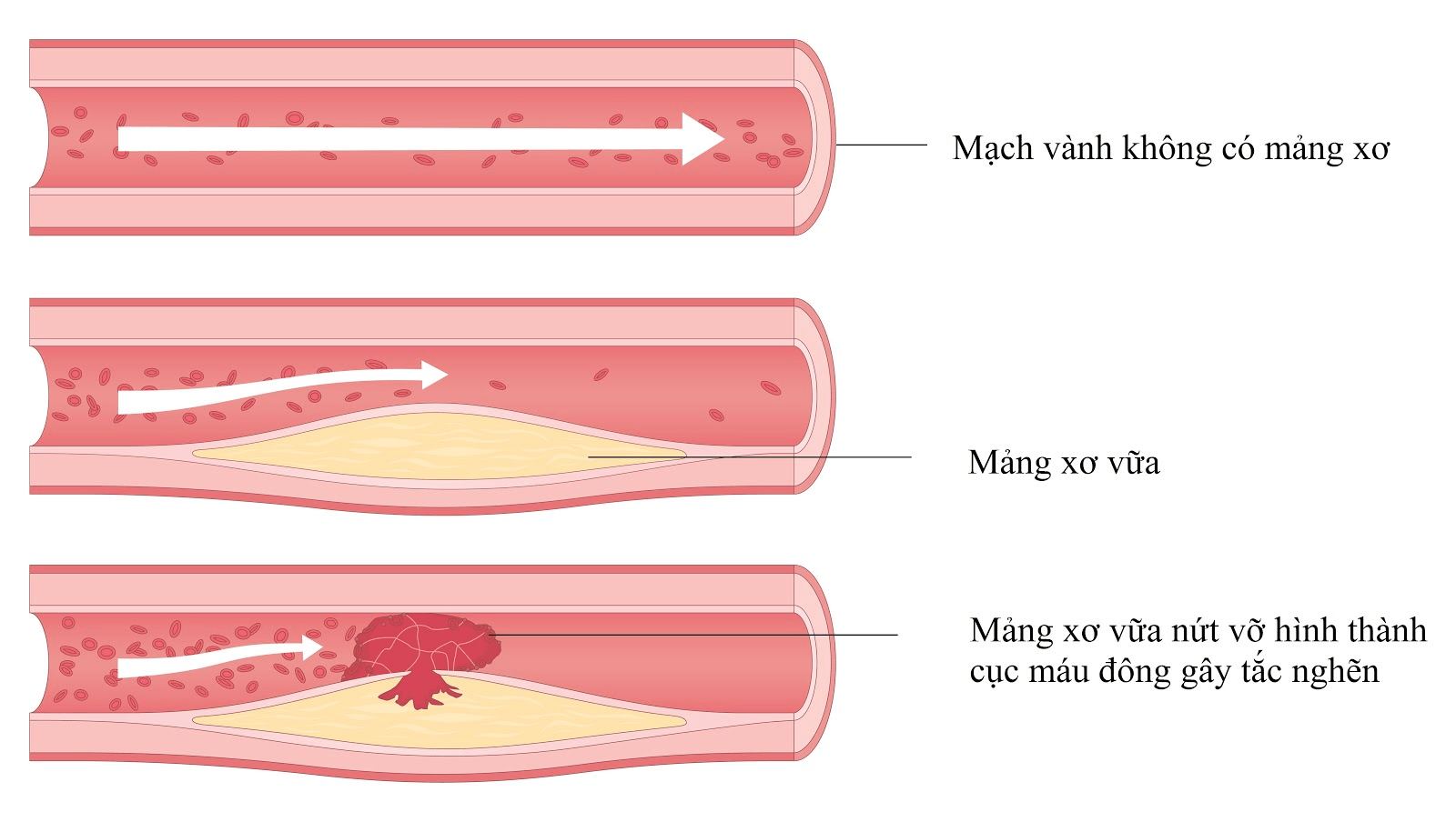 anh mang xo vua bi nut vo 2 1 - Sản phẩm được bán bởi Gimedi Pharma