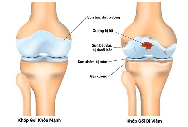 Đầu gối bắt đầu đau nhẹ? Đây có thể không còn là chuyện nhỏ 2 - Gimedi Pharma sun khop 1 - Sản phẩm được bán bởi Gimedi Pharma