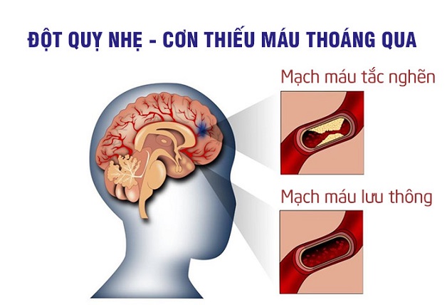 thieu mau nao cuc bo thoang qua la gi 1 - Sản phẩm được bán bởi Gimedi Pharma