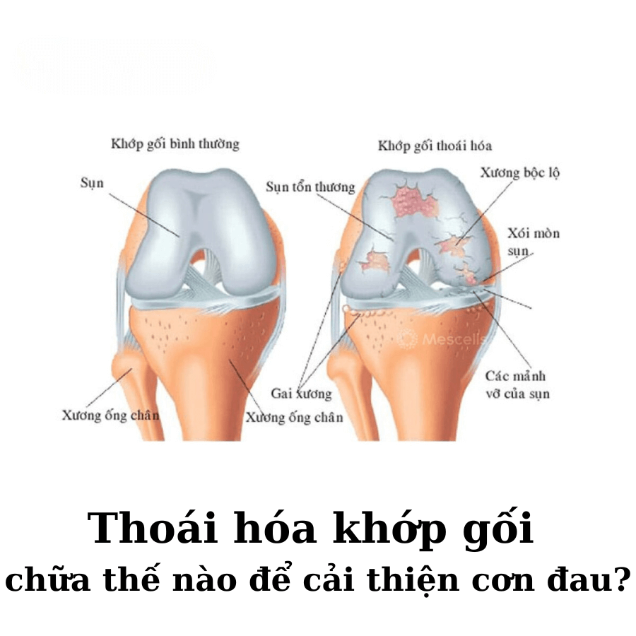 Thoai hoa khop goi chua the nao de cai thien con dau 2 1 - Sản phẩm được bán bởi Gimedi Pharma