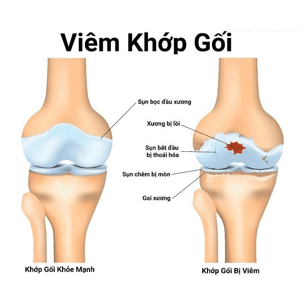 viem khop goi la gi - Sản phẩm được bán bởi Gimedi Pharma