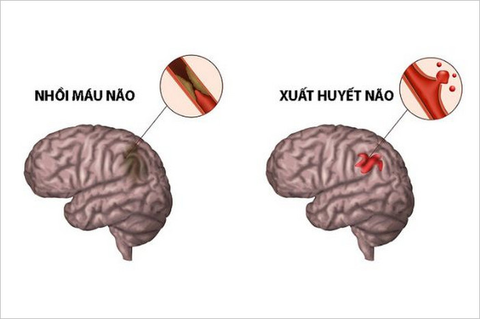 Thời gian vàng giúp bệnh nhân tai biến phục hồi nhanh