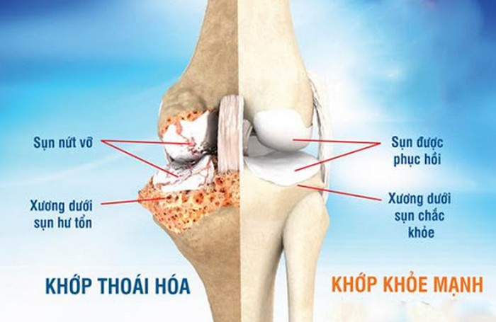 Thoái hóa khớp là gì?