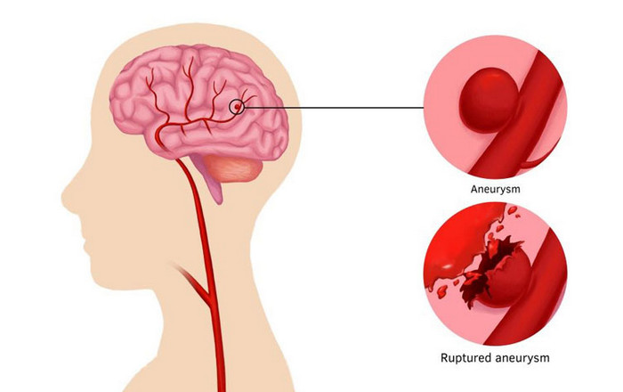 Vỡ mạch máu não gây nguy hiểm tới hệ thần kinh, dễ tử vong