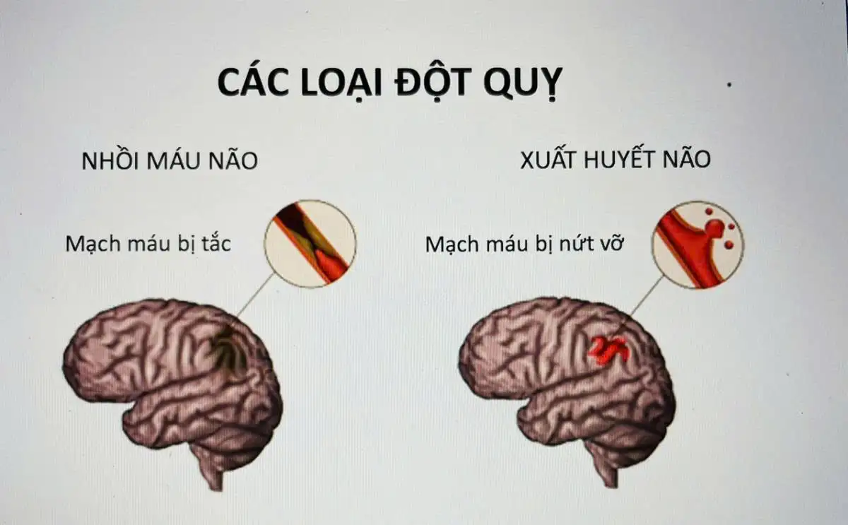 Đột quỵ: Nguyên nhân và cách phòng ngừa