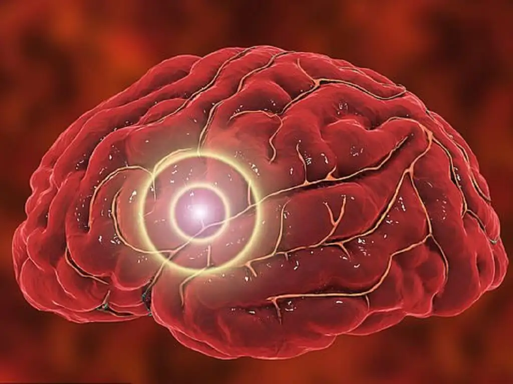 Những thói quen xấu khiến bạn dễ bị đột quỵ