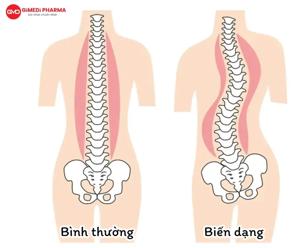 thoái hóa cột sống thắt lưng và 5 biến chứng nguy cơ