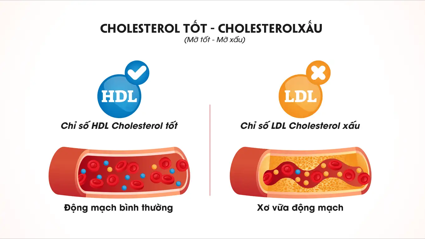 Cholesterol cao đẩy nhanh tốc độ xơ vữa mạch vành