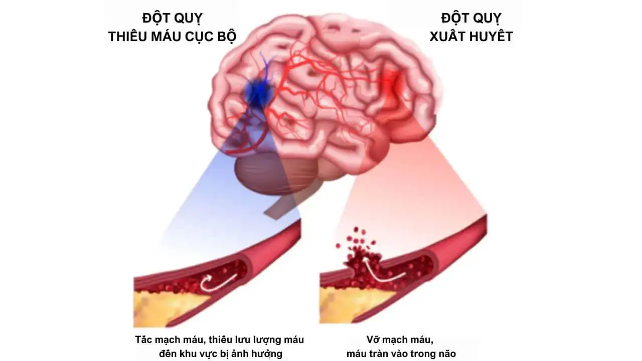 Đột quỵ Nguyên nhân, dấu hiệu nhận biết, cách phòng tránh (1) Đột quỵ Nguyên nhân, dấu hiệu nhận biết, cách phòng tránh (1)