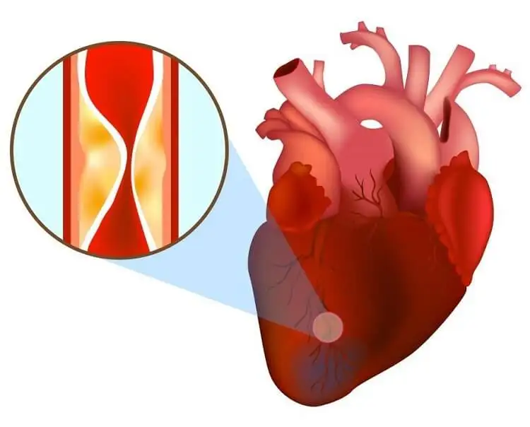 Nhồi máu cơ tim (1) Nhồi máu cơ tim (1)