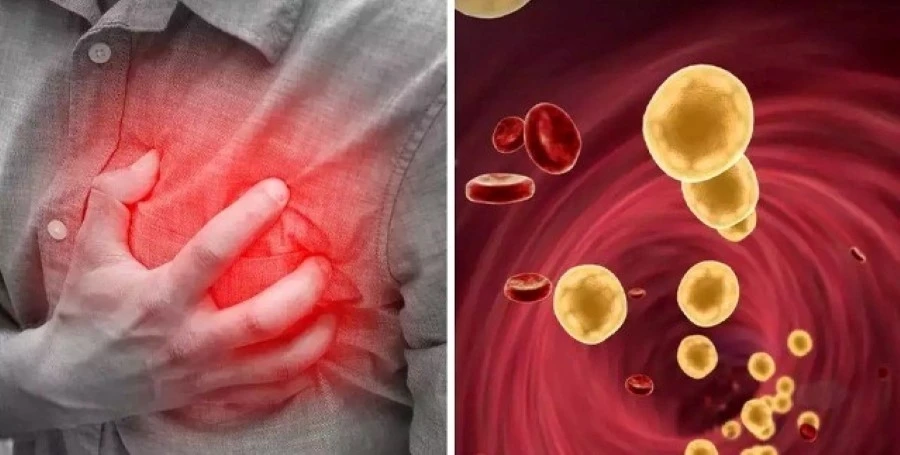 Những dấu hiệu cảnh báo sớm mỡ máu cao tuyệt đối đừng coi nhẹ