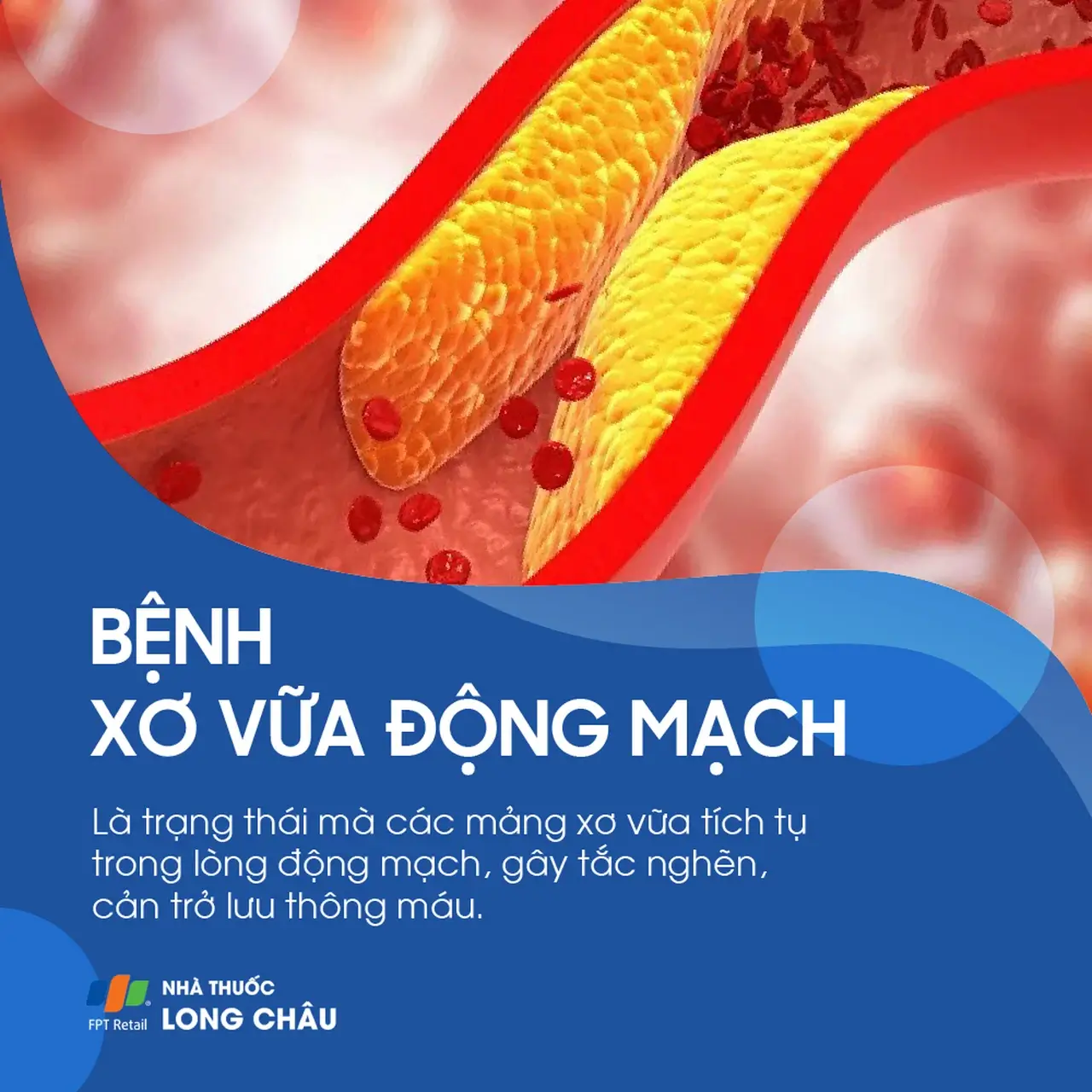 Xơ vữa động mạch là gì (1)