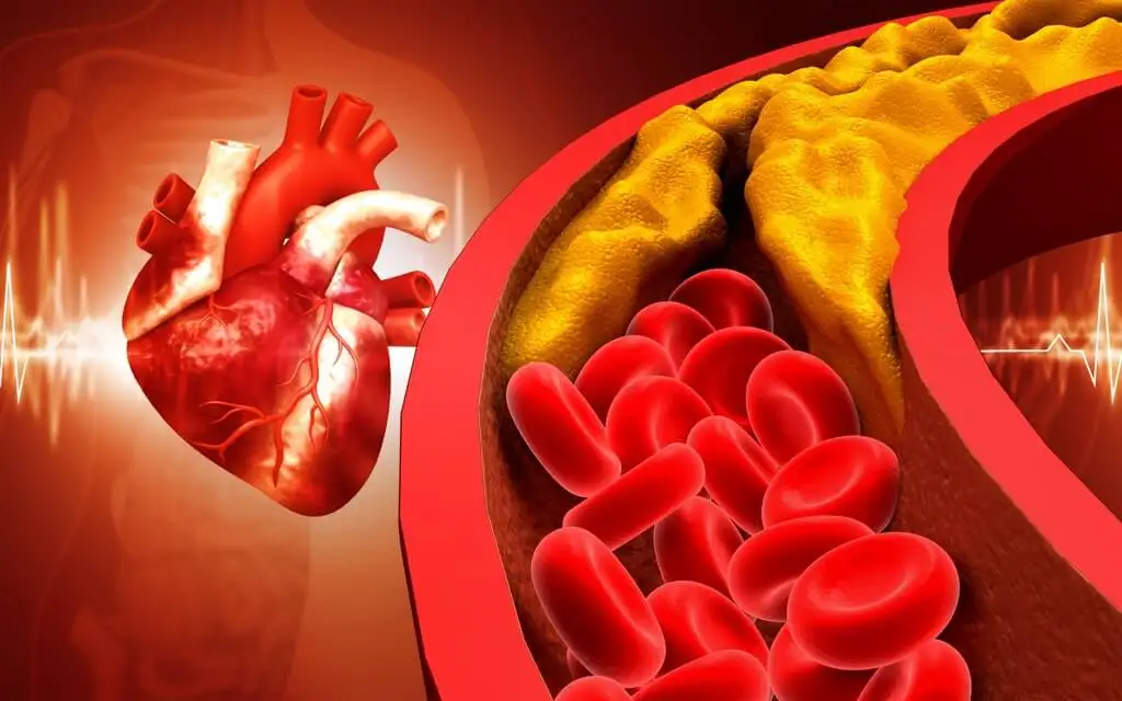 mỡ máu cao (1) mỡ máu cao (1)